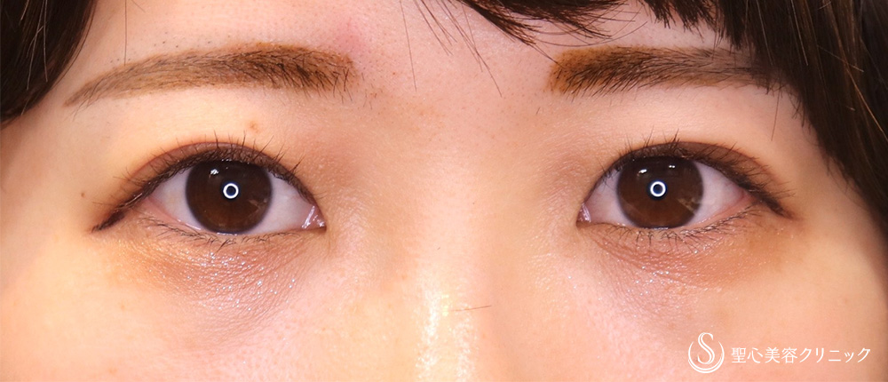 【20代女性・眼瞼下垂手術で目の開きを改善】眼瞼下垂（切開法／挙筋前転法）（3ヶ月後） After 