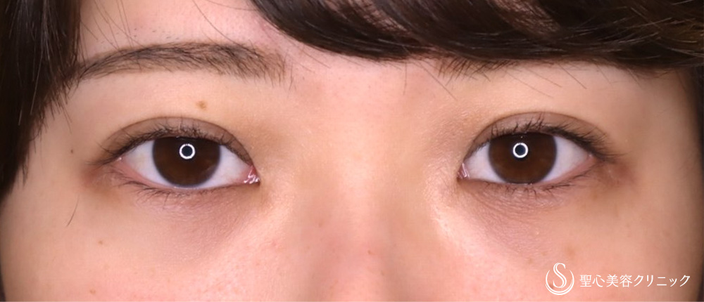 【20代女性・眼瞼下垂手術で目の開きを改善】眼瞼下垂（切開法／挙筋前転法）（3ヶ月後） Before 