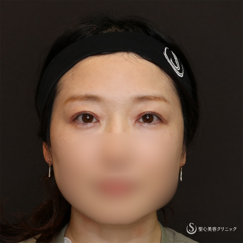 【40代女性・華やかぱっちり目元】二重術（切開法）＋脱脂（1ヶ月後） After 名古屋院