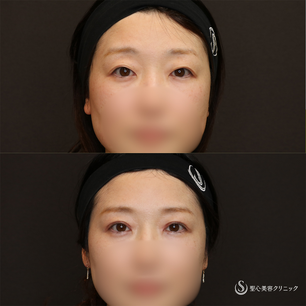 【40代女性・華やかぱっちり目元】二重術（切開法）＋脱脂（1ヶ月後） After 名古屋　目を大きく　二重　二重切開