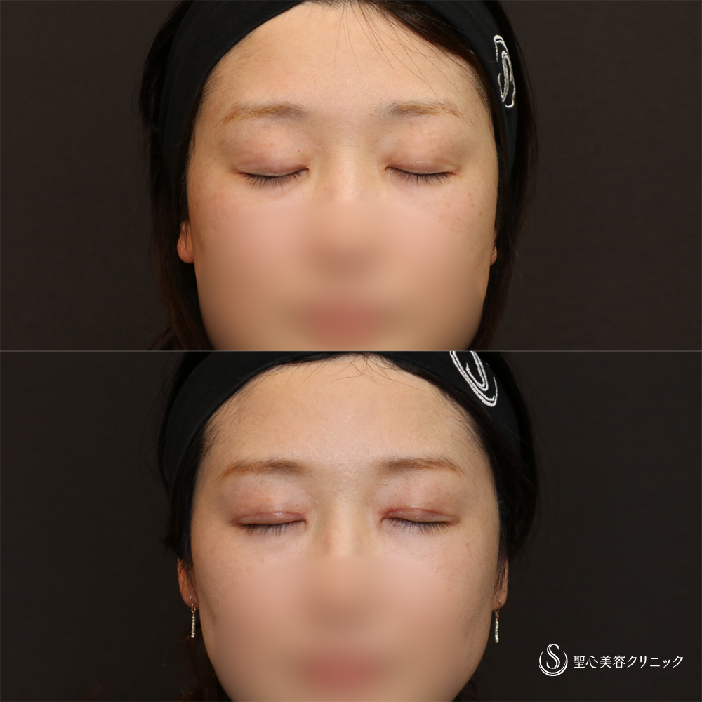 【40代女性・華やかぱっちり目元】二重術（切開法）＋脱脂（1ヶ月後） After 名古屋　目を大きく　二重　二重切開