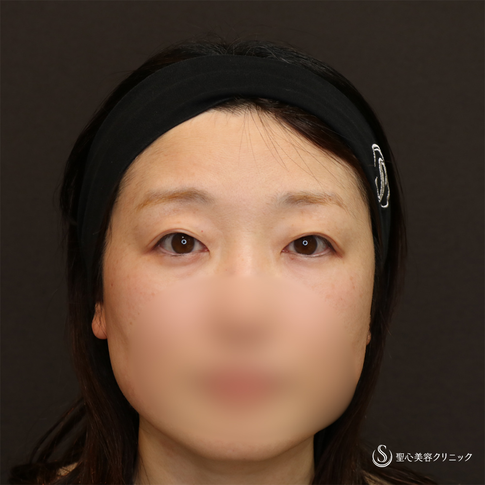 【40代女性・華やかぱっちり目元】二重術（切開法）＋脱脂（1ヶ月後） Before 