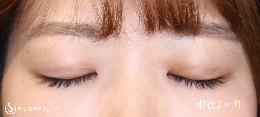 【20代女性・埋没法でスッキリしたお目元に】マイクロメソッド+α（二重埋没法）（1ヶ月後） After 