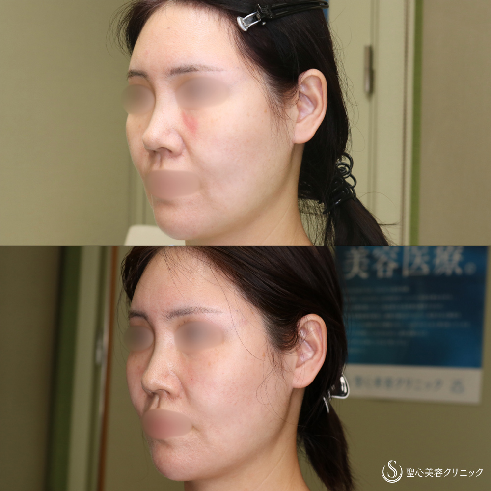 【40代女性・フェイスラインのリフトアップ】アンカーMAX（1ヶ月後） After 名古屋院