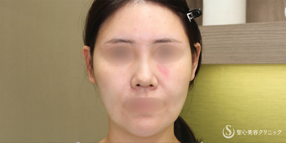 【40代女性・フェイスラインのリフトアップ】アンカーMAX（1ヶ月後） Before 