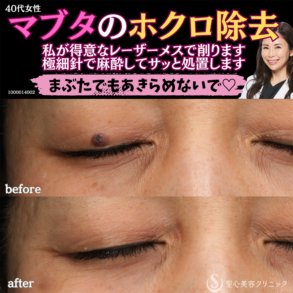 【40代女性・目のキワのホクロ除去】電気凝固法（1年後） After 