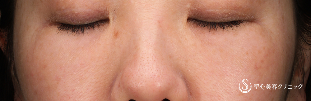 【40代女性・目の下を自然に改善】プレミアムPRP皮膚再生療法（1ヶ月後） After 