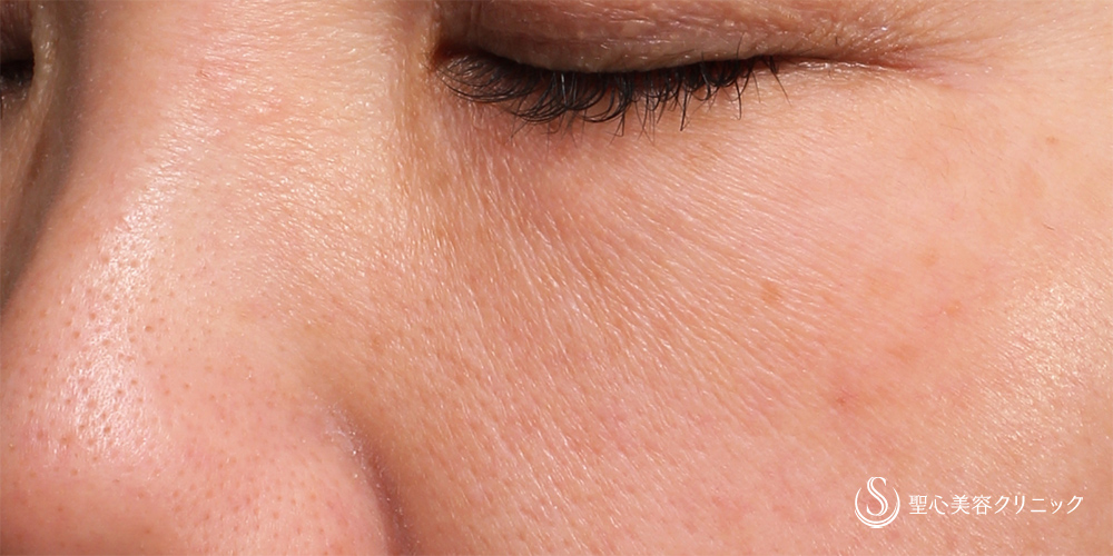 【40代女性・目の下を自然に改善】プレミアムPRP皮膚再生療法（1ヶ月後） After 