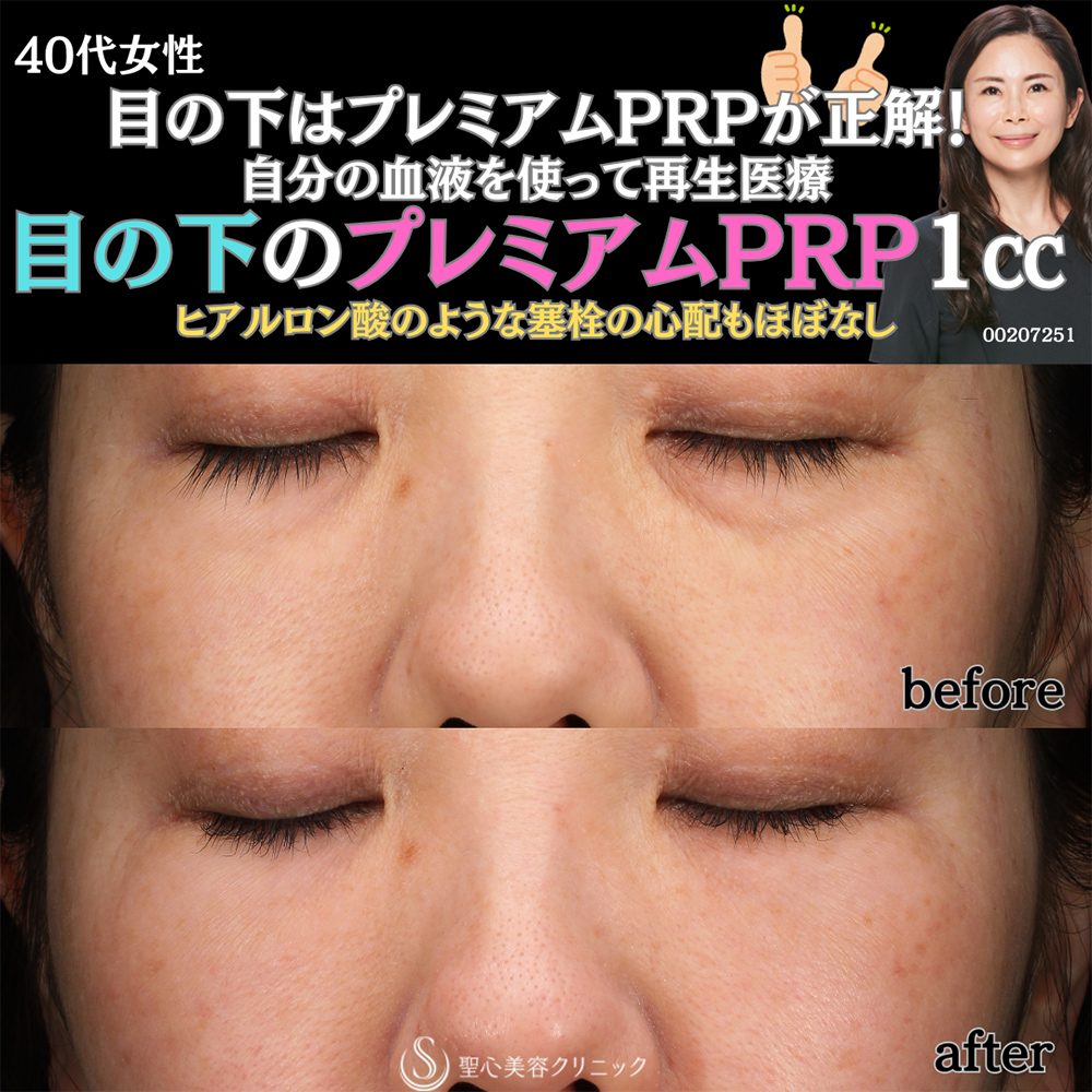 【40代女性・目の下を自然に改善】プレミアムPRP皮膚再生療法（1ヶ月後） After 