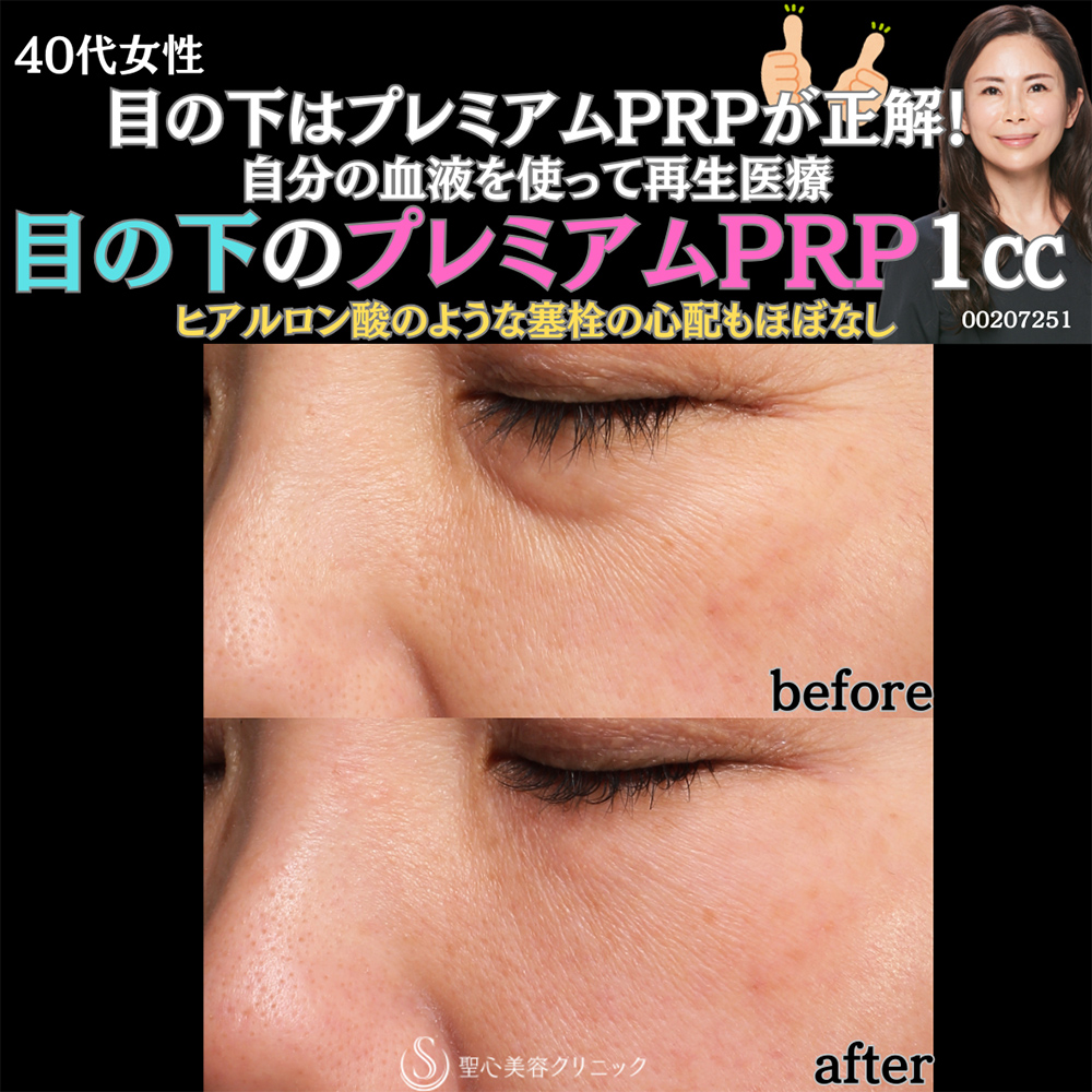【40代女性・目の下を自然に改善】プレミアムPRP皮膚再生療法（1ヶ月後） After 
