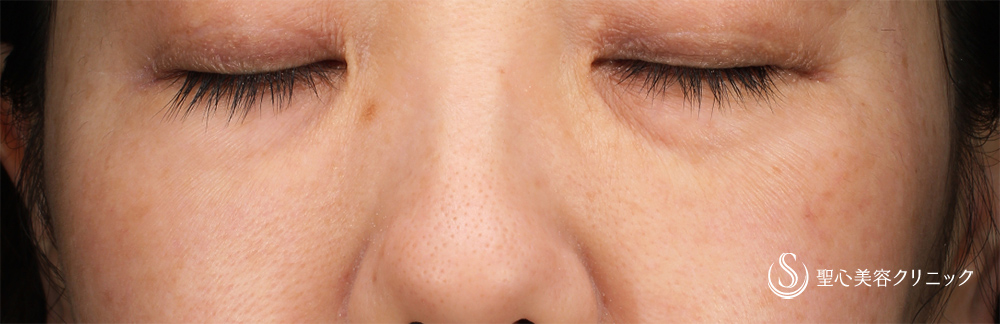 【40代女性・目の下を自然に改善】プレミアムPRP皮膚再生療法（1ヶ月後） Before 