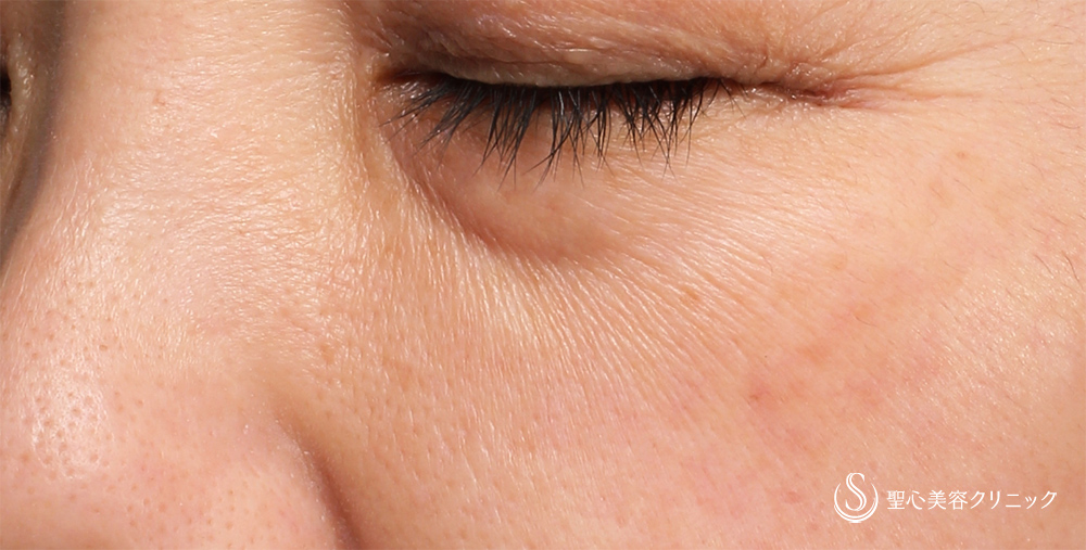 【40代女性・目の下を自然に改善】プレミアムPRP皮膚再生療法（1ヶ月後） Before 