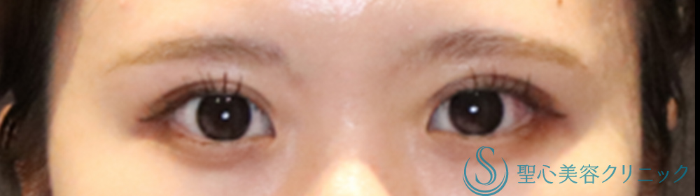 【20代女性・ハッキリした華やかな二重に】マイクロメソッド＋α（二重埋没法）（術後4日目） After 