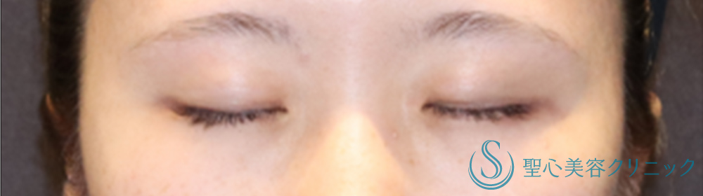 【20代女性・ハッキリした華やかな二重に】マイクロメソッド＋α（二重埋没法）（術後4日目） Before 