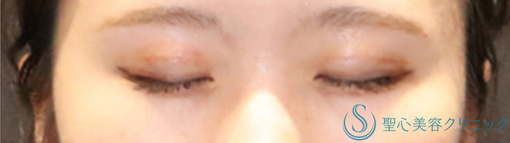 【20代女性・ハッキリした華やかな二重に】マイクロメソッド＋α（二重埋没法）（術後4日目） After 