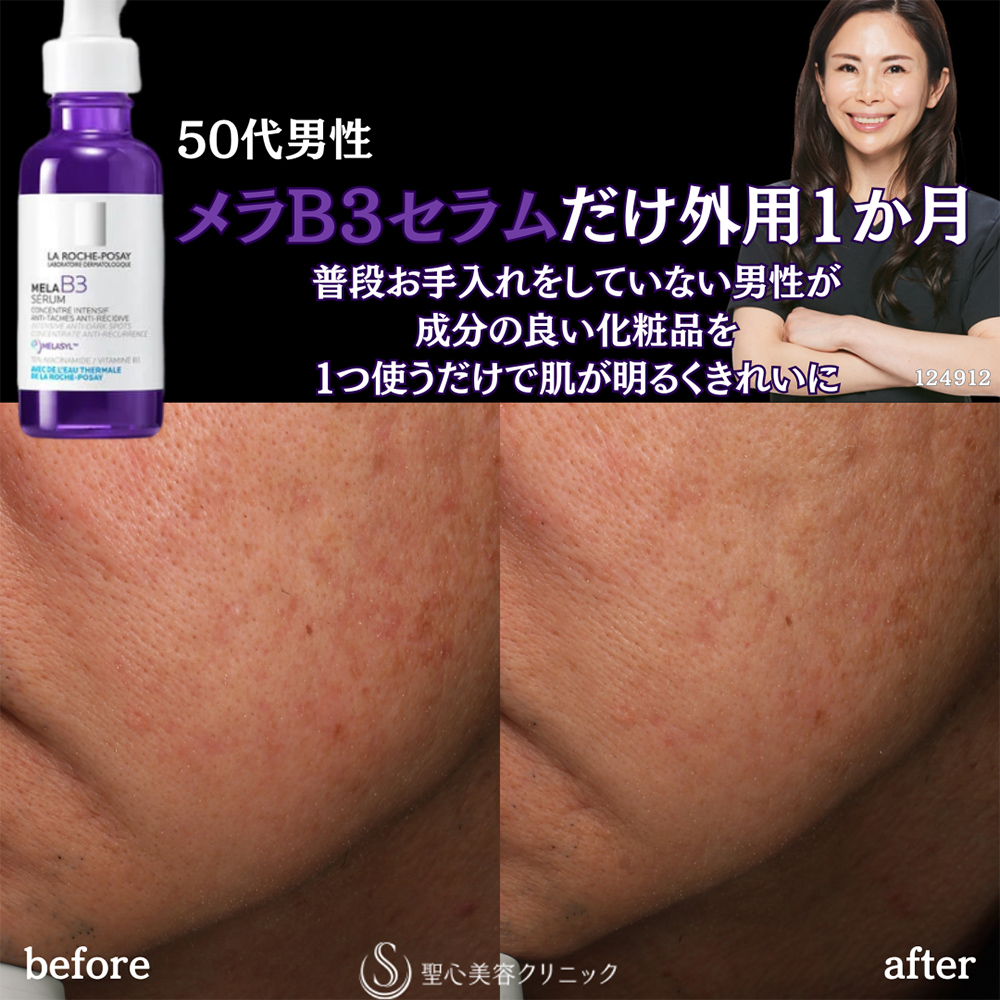 【50代男性・顔のクスミ】ラ ロッシュ ポゼ メラ B3 セラム外用（1ヶ月後） After 