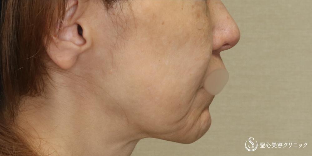 【50代女性・長期的なリフトアップ】フェイスリフト＋脂肪吸引（頬）（1ヶ月後） Before 