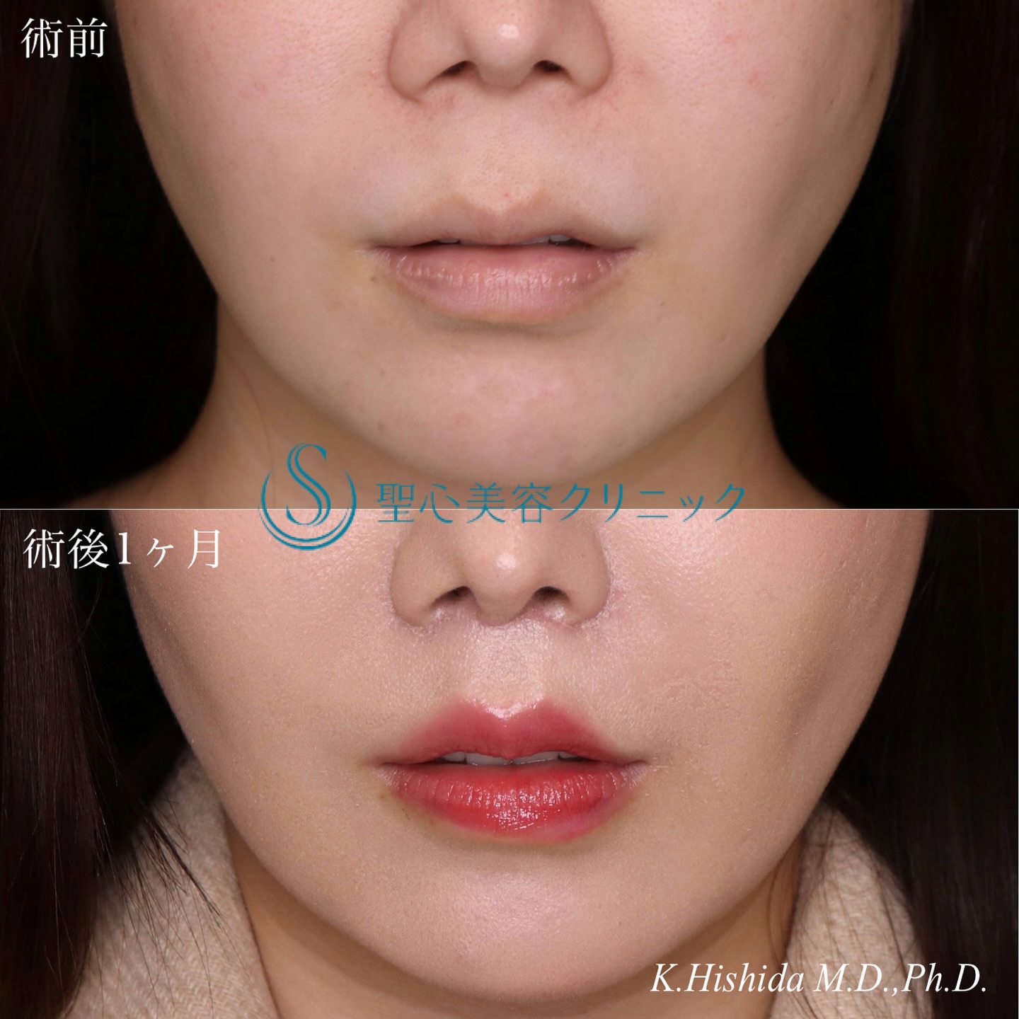 【30代女性・人中を短くしたい】プレミアムリップリフト（プレミアム人中短縮術）（1ヶ月後） After 