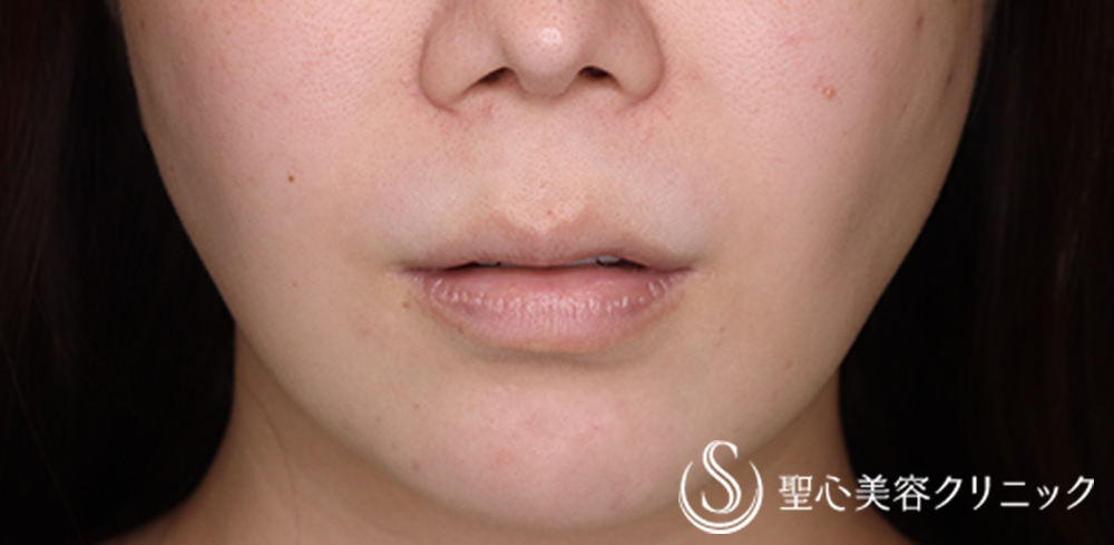 【30代女性・人中を短くしたい】プレミアムリップリフト（プレミアム人中短縮術）（1ヶ月後） Before 