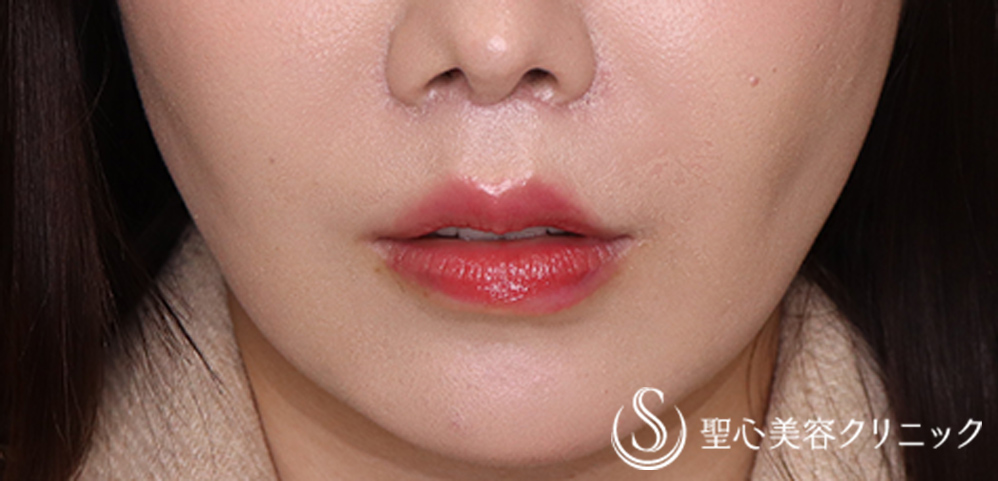 【30代女性・人中を短くしたい】プレミアムリップリフト（プレミアム人中短縮術）（1ヶ月後） After 