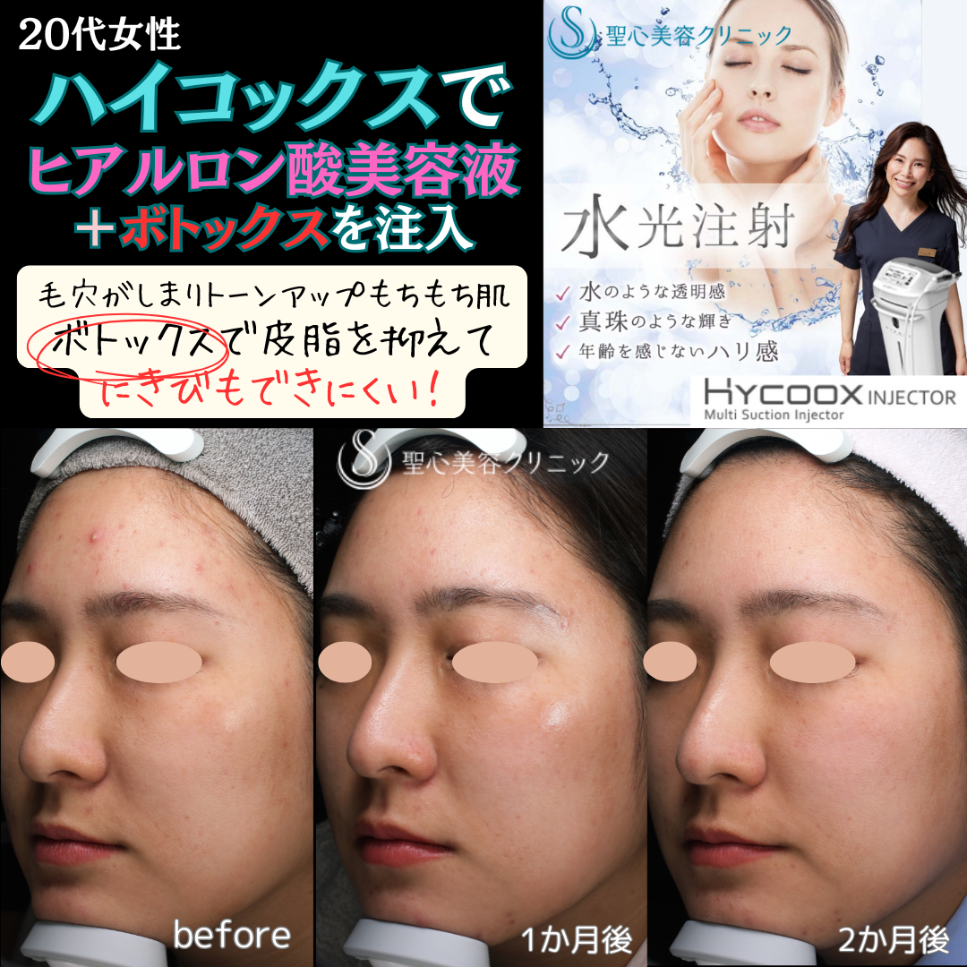 【20代女性・ニキビ毛穴】水光注射（2ヶ月後） After 