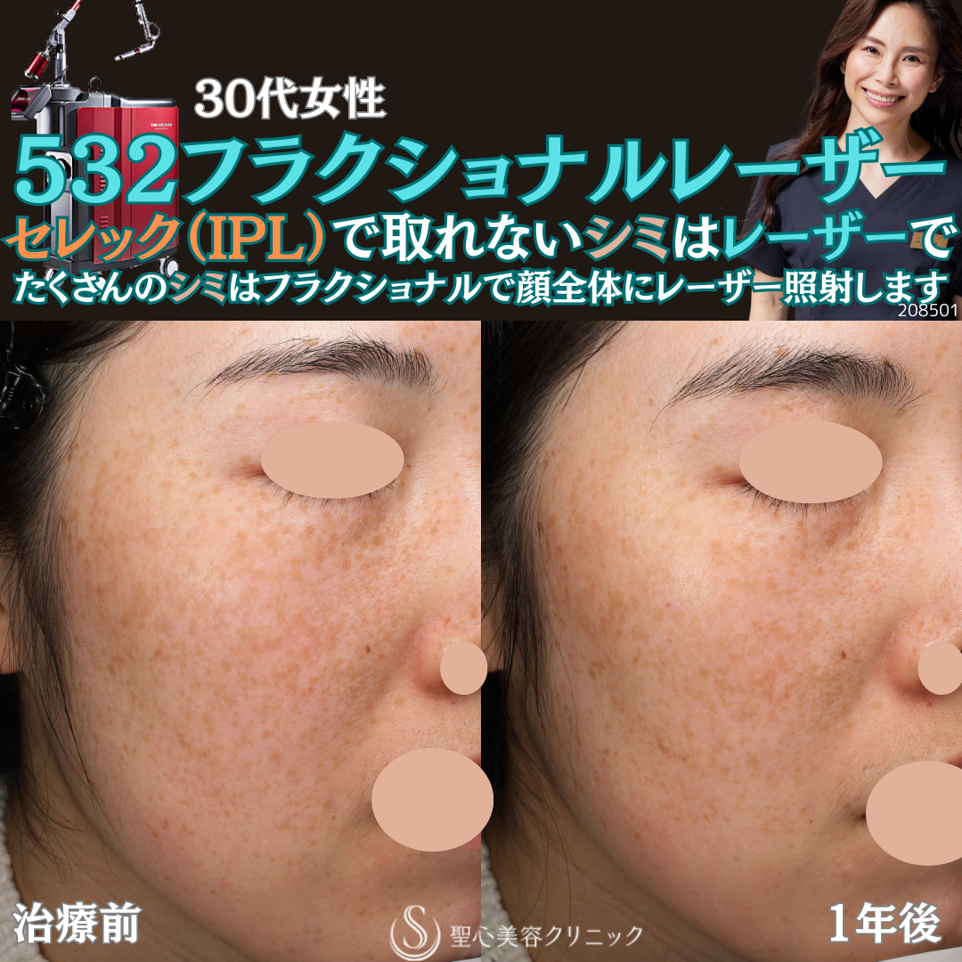 【30代女性・顔のシミ】532フラクショナルレーザー（1年後） After 
