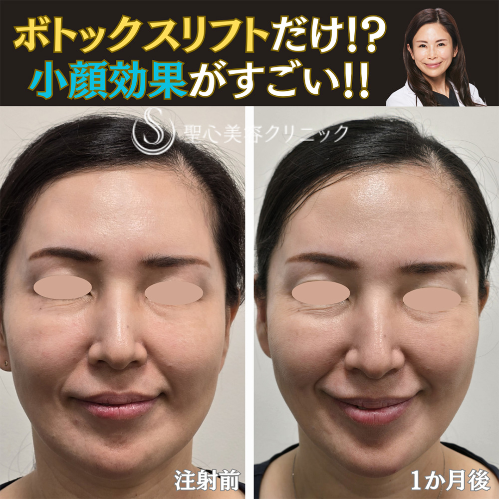 【40代女性・小顔】ボトックスリフト（1ヶ月後） After 