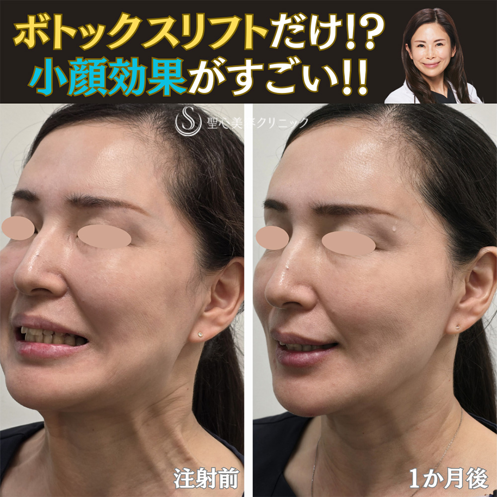 【40代女性・小顔】ボトックスリフト（1ヶ月後） After 