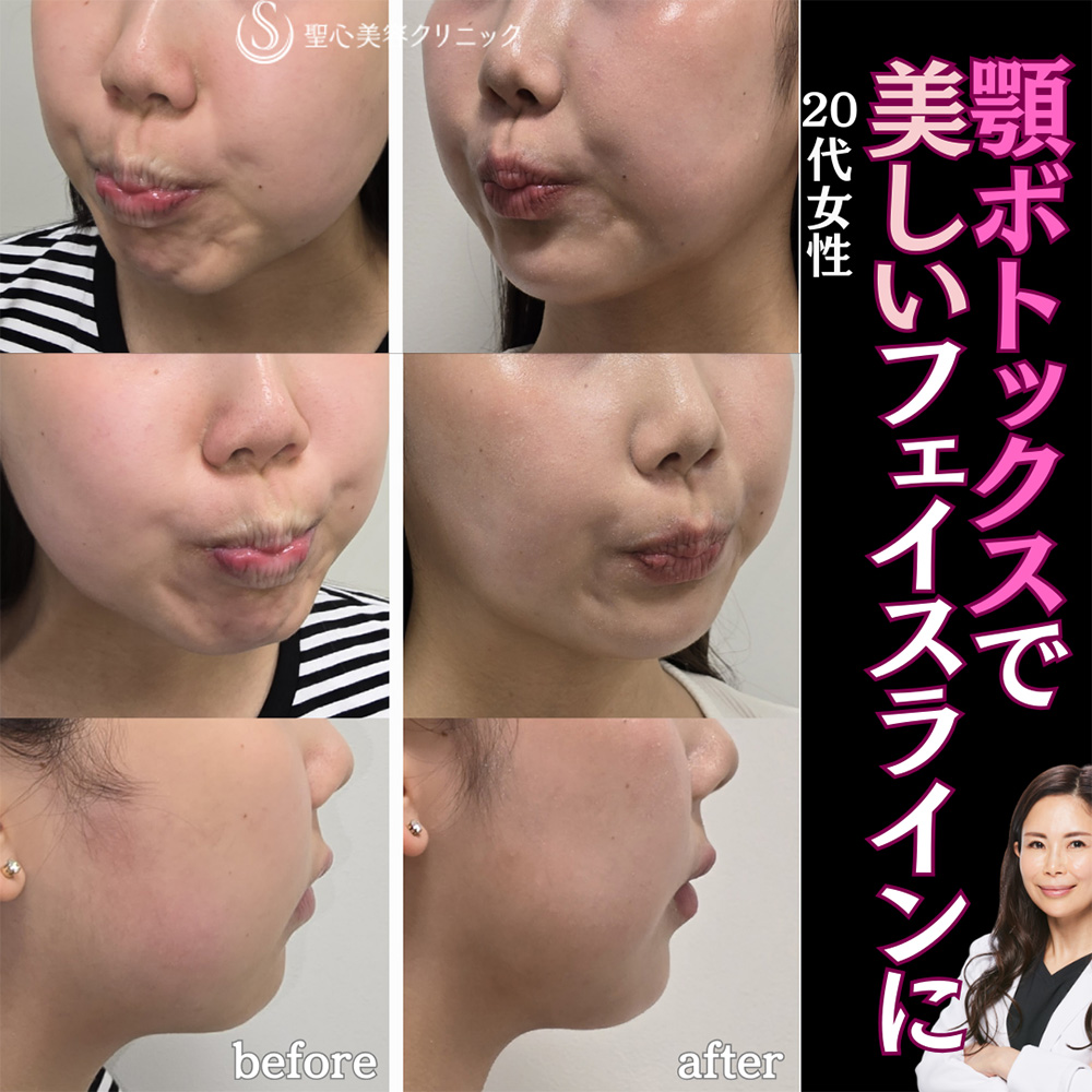【20代女性・ボトックスできれいなフェイスラインに】ボトックス注入（顎）（直後） After 