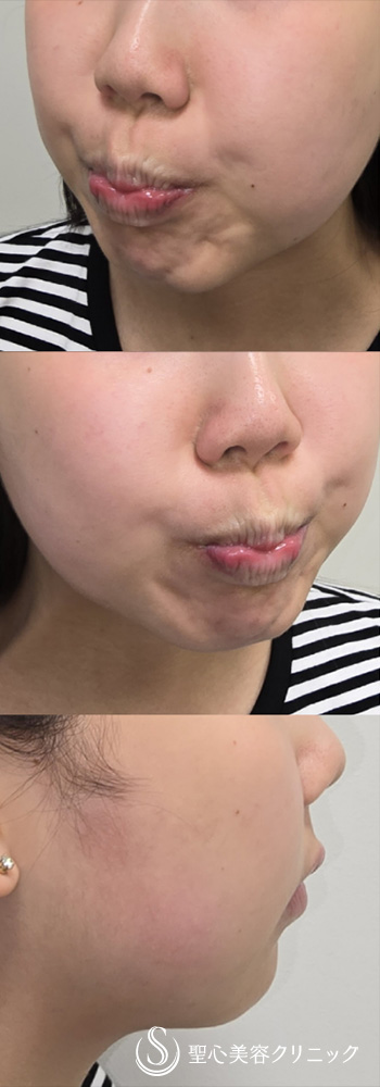 【20代女性・ボトックスできれいなフェイスラインに】ボトックス注入（顎）（直後） Before 