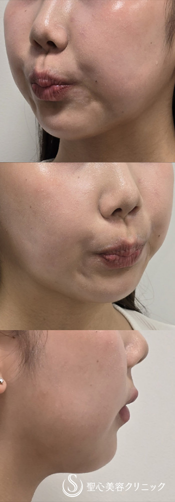 【20代女性・ボトックスできれいなフェイスラインに】ボトックス注入（顎）（直後） After 