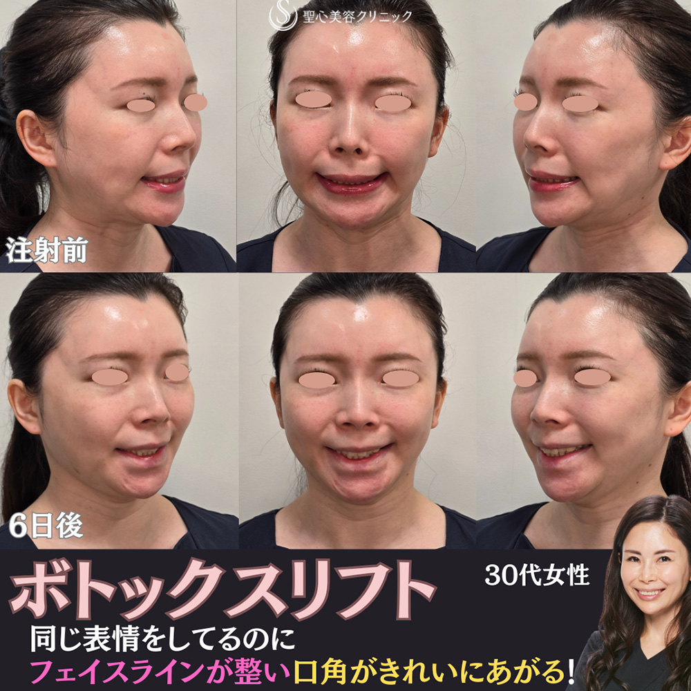 【30代女性・広頚筋のボトックスで小顔に】ボトックスリフト（6日後） After 