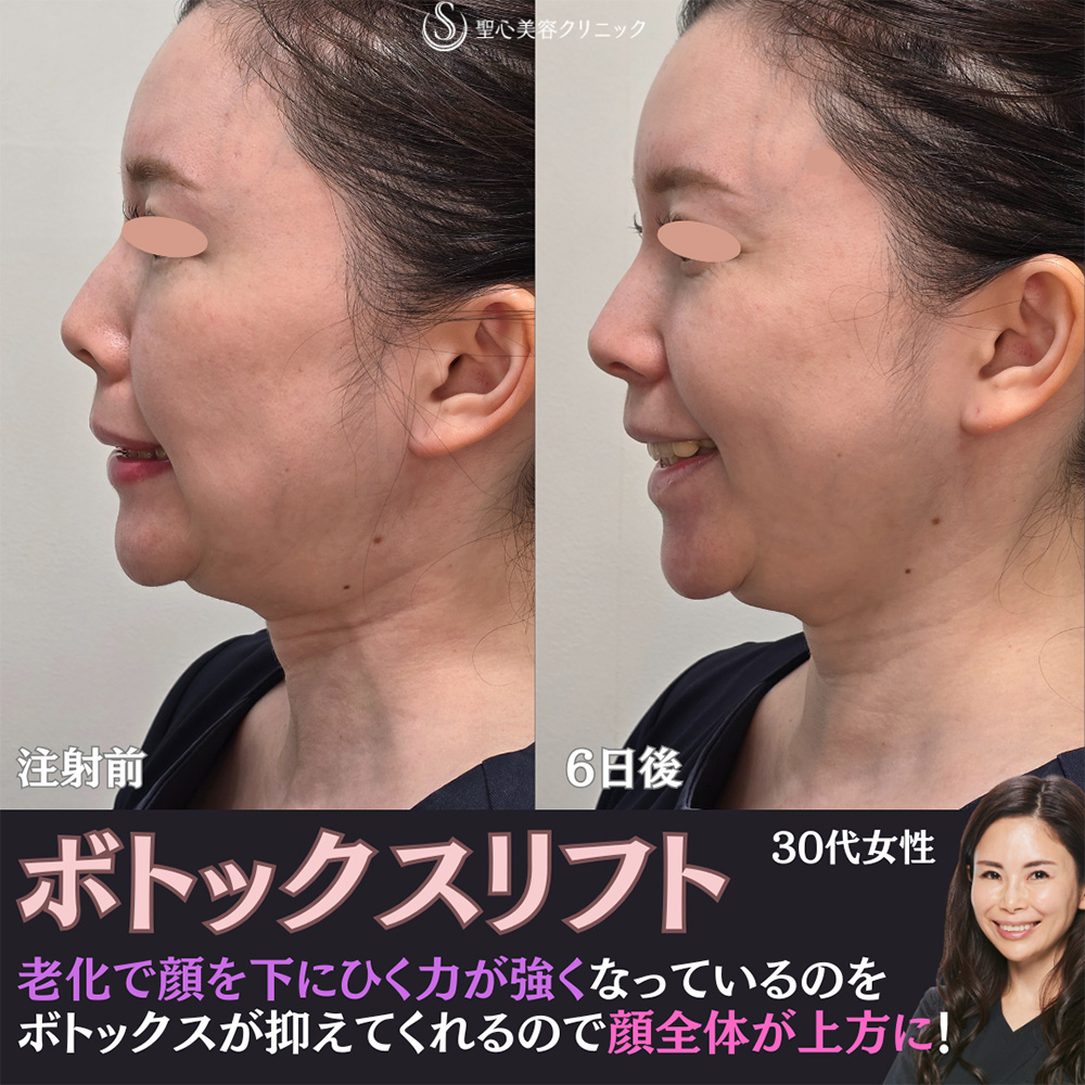 【30代女性・広頚筋のボトックスで小顔に】ボトックスリフト（6日後） After 