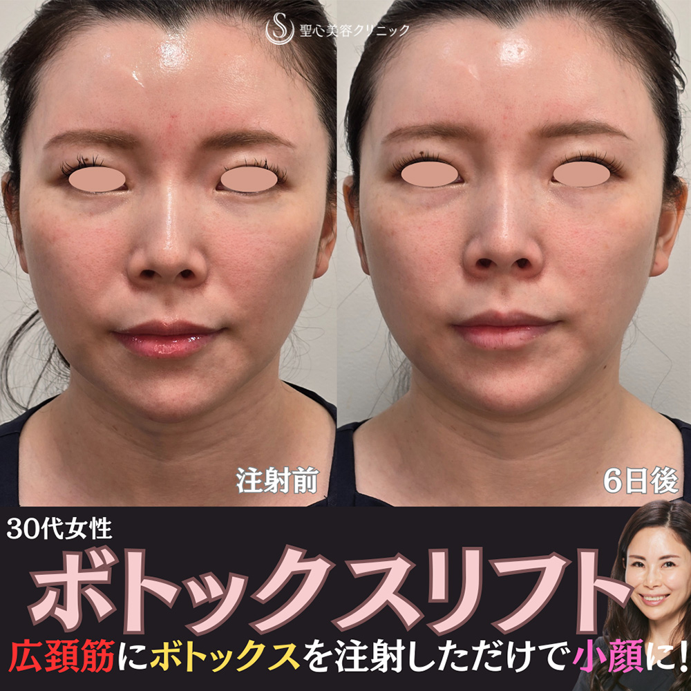 【30代女性・広頚筋のボトックスで小顔に】ボトックスリフト（6日後） After 