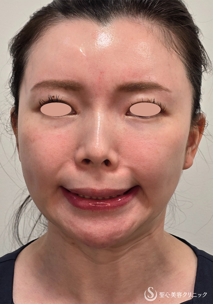 【30代女性・広頚筋のボトックスで小顔に】ボトックスリフト（6日後） Before 