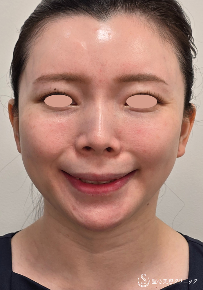 【30代女性・広頚筋のボトックスで小顔に】ボトックスリフト（6日後） After 