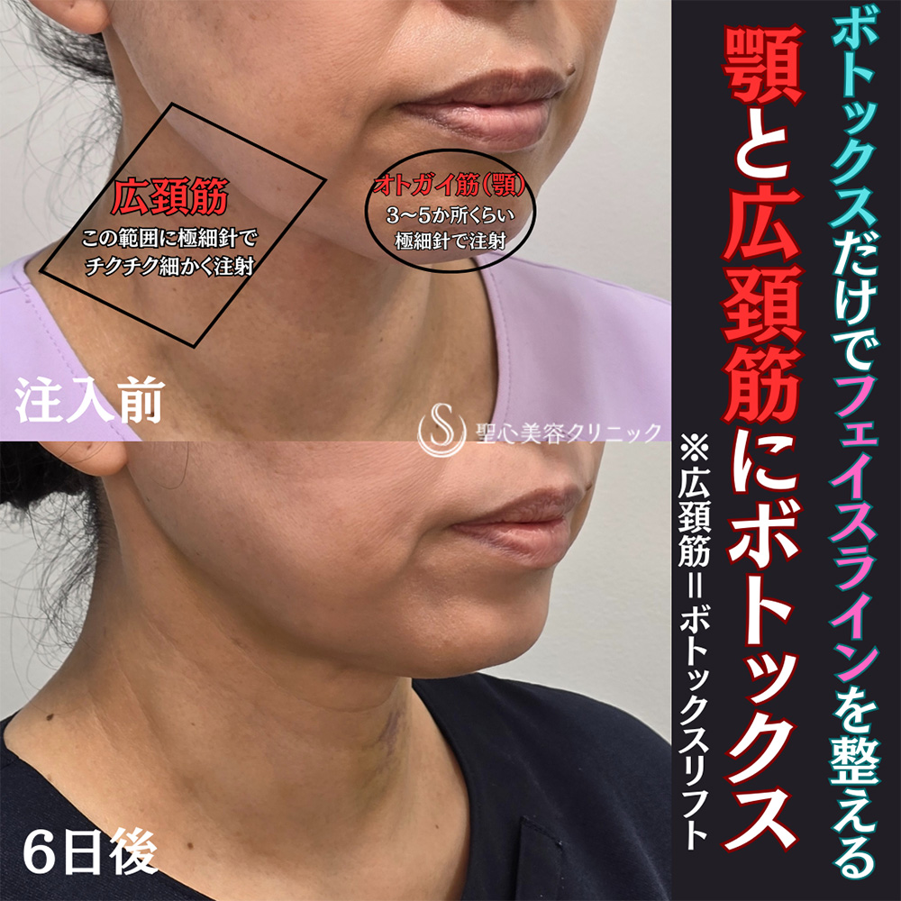 【40代女性・小顔に】ボトックスリフト＋ボトックス（顎）（6日後） After 