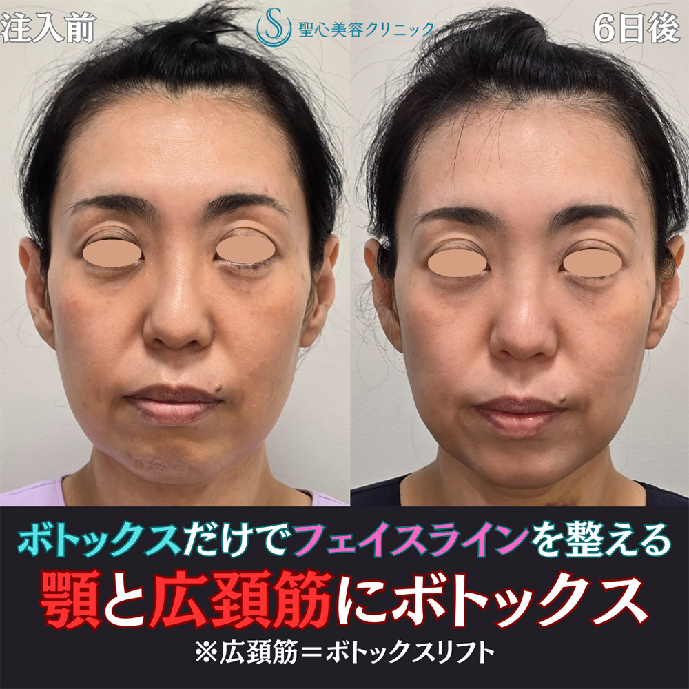 【40代女性・小顔に】ボトックスリフト＋ボトックス（顎）（6日後） After 