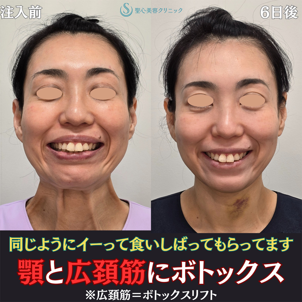 【40代女性・小顔に】ボトックスリフト＋ボトックス（顎）（6日後） After 