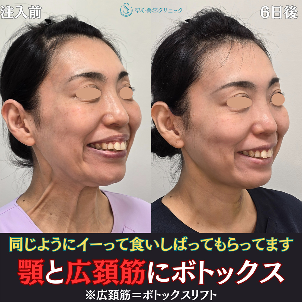【40代女性・小顔に】ボトックスリフト＋ボトックス（顎）（6日後） After 