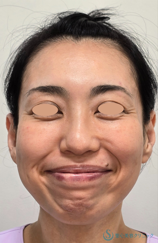 【40代女性・小顔に】ボトックスリフト＋ボトックス（顎）（6日後） Before 