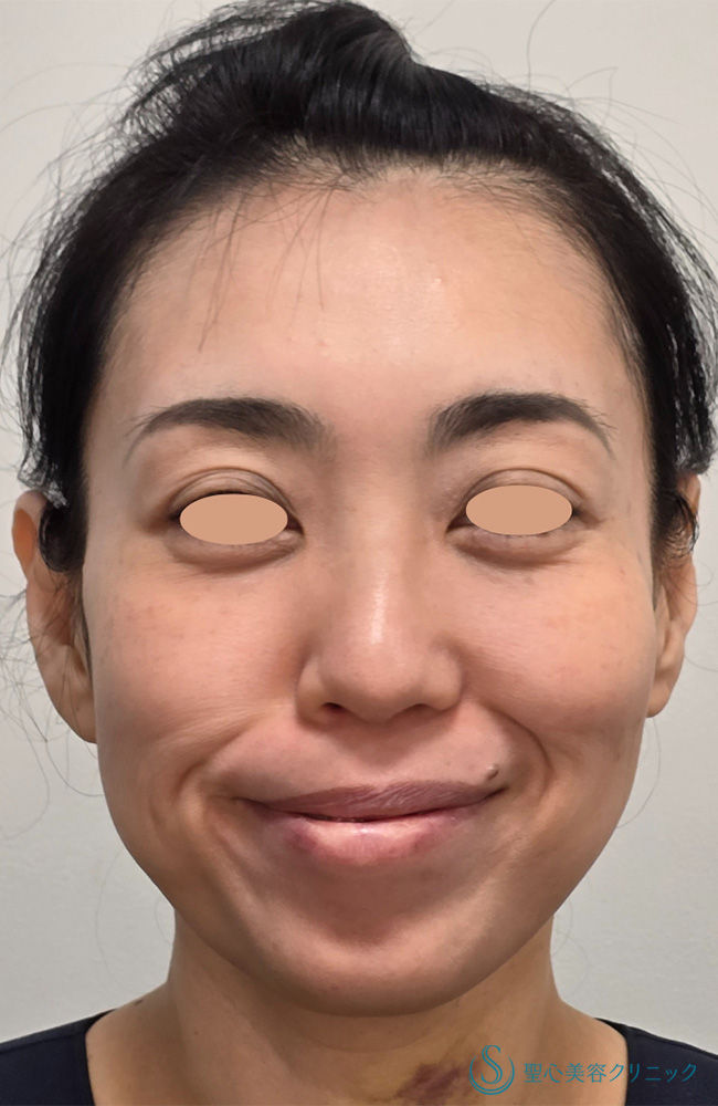 【40代女性・小顔に】ボトックスリフト＋ボトックス（顎）（6日後） After 