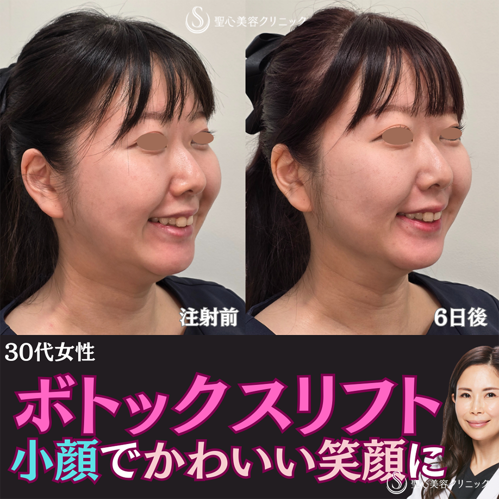 【30代女性・ボトックスリフトだけで小顔に】ボトックスリフト（6日後） After 