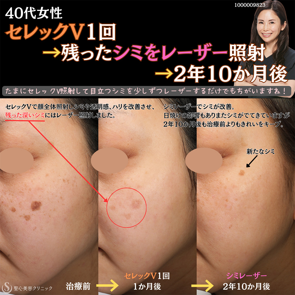 【40代女性・シミ】 CellecV（セレックV）（1回）＋しみレーザー（2年10ヶ月後） After 