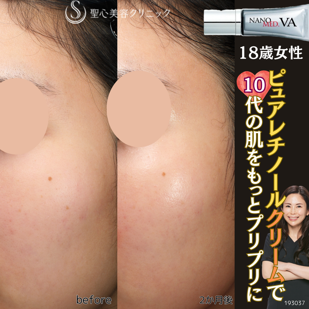 【18歳女性・肌ツヤ】ナノメッド VA エッセンス外用（2ヶ月後） After 