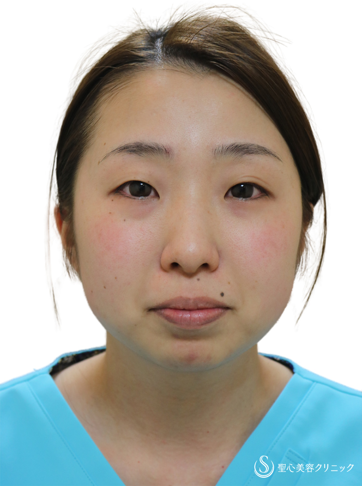 【30代女性・顔のラインを整える】プレミアムPRP皮膚再生療法（額）＋ヒアルロン酸注入（顎）＋ホクロ除去＋Ｎトレチノイン外用（4年5ヶ月後） Before 