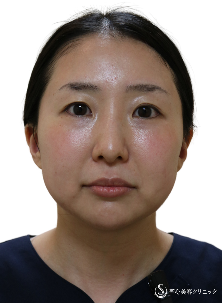 【30代女性・顔のラインを整える】プレミアムPRP皮膚再生療法（額）＋ヒアルロン酸注入（顎）＋ホクロ除去＋Ｎトレチノイン外用（4年5ヶ月後） After 