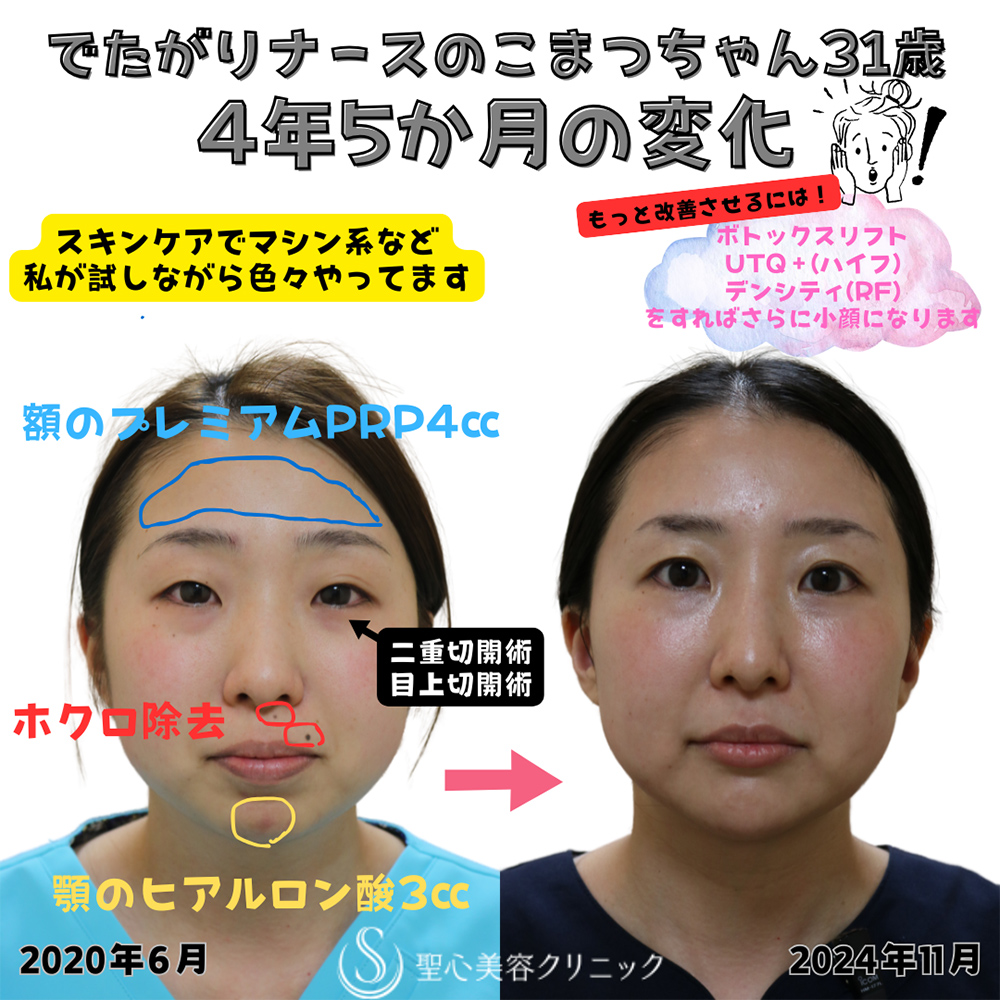 【30代女性・顔のラインを整える】プレミアムPRP皮膚再生療法（額）＋ヒアルロン酸注入（顎）＋ホクロ除去＋Ｎトレチノイン外用（4年5ヶ月後） After 