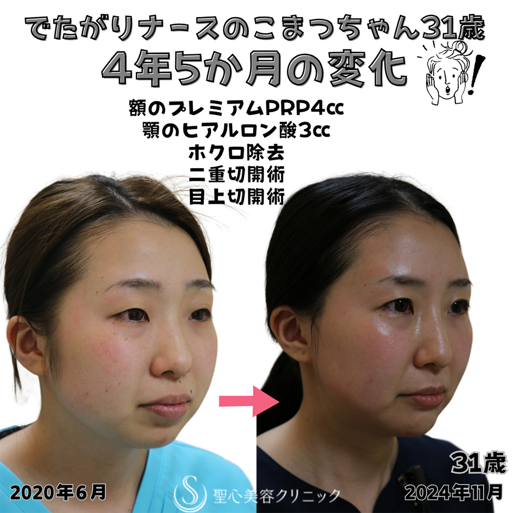 【30代女性・顔のラインを整える】プレミアムPRP皮膚再生療法（額）＋ヒアルロン酸注入（顎）＋ホクロ除去＋Ｎトレチノイン外用（4年5ヶ月後） After 