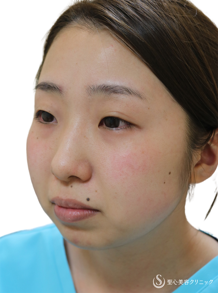 【30代女性・顔のラインを整える】プレミアムPRP皮膚再生療法（額）＋ヒアルロン酸注入（顎）＋ホクロ除去＋Ｎトレチノイン外用（4年5ヶ月後） Before 